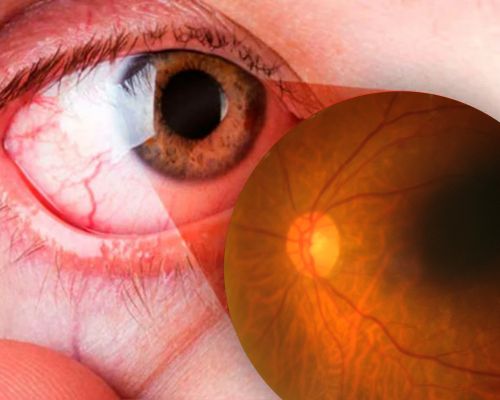 Cuidado de Retina Diabética en SLp